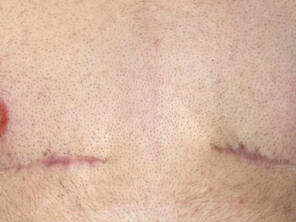 Breaking the Stigma: how nipple tattoos can greatly help in gender affirmation